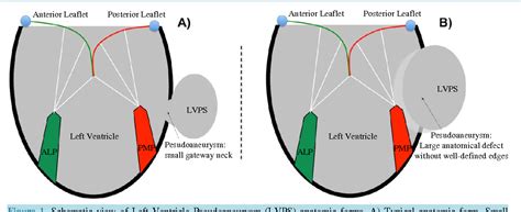 lv angio|lv pseudoaneurysm vs true aneurysm.